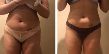Before and after Fat freezing